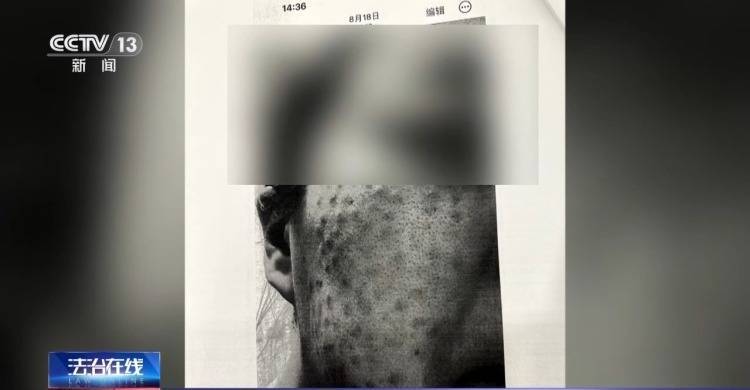 皇冠信用网代理占成
_打美容针竟致十级伤残皇冠信用网代理占成
！在医生家中做医美 出了事谁负责？